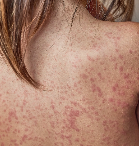 Espalda con psoriasis