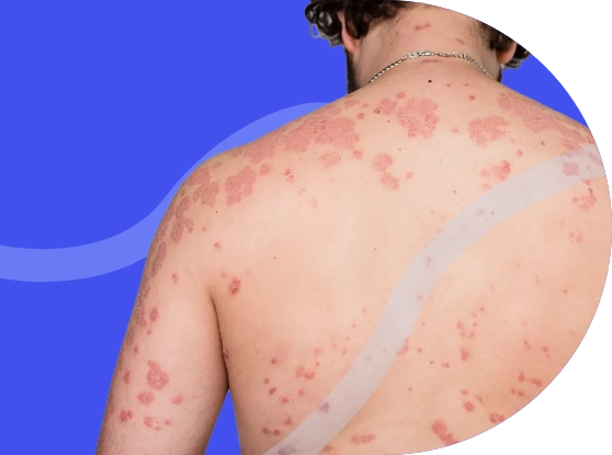 Espalda con psoriasis